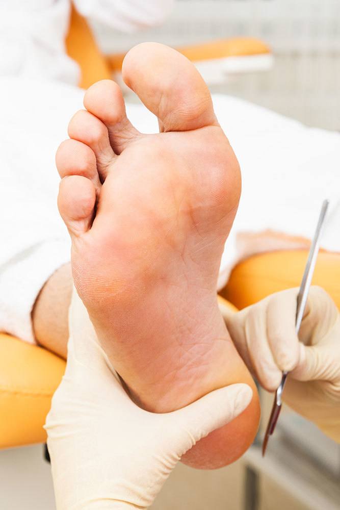 Podiatrist Removing Calluses With A Scalpel