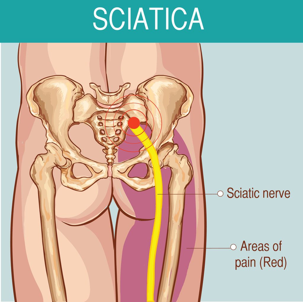 Sciatica: Symptoms and causes of sciatic nerve pain