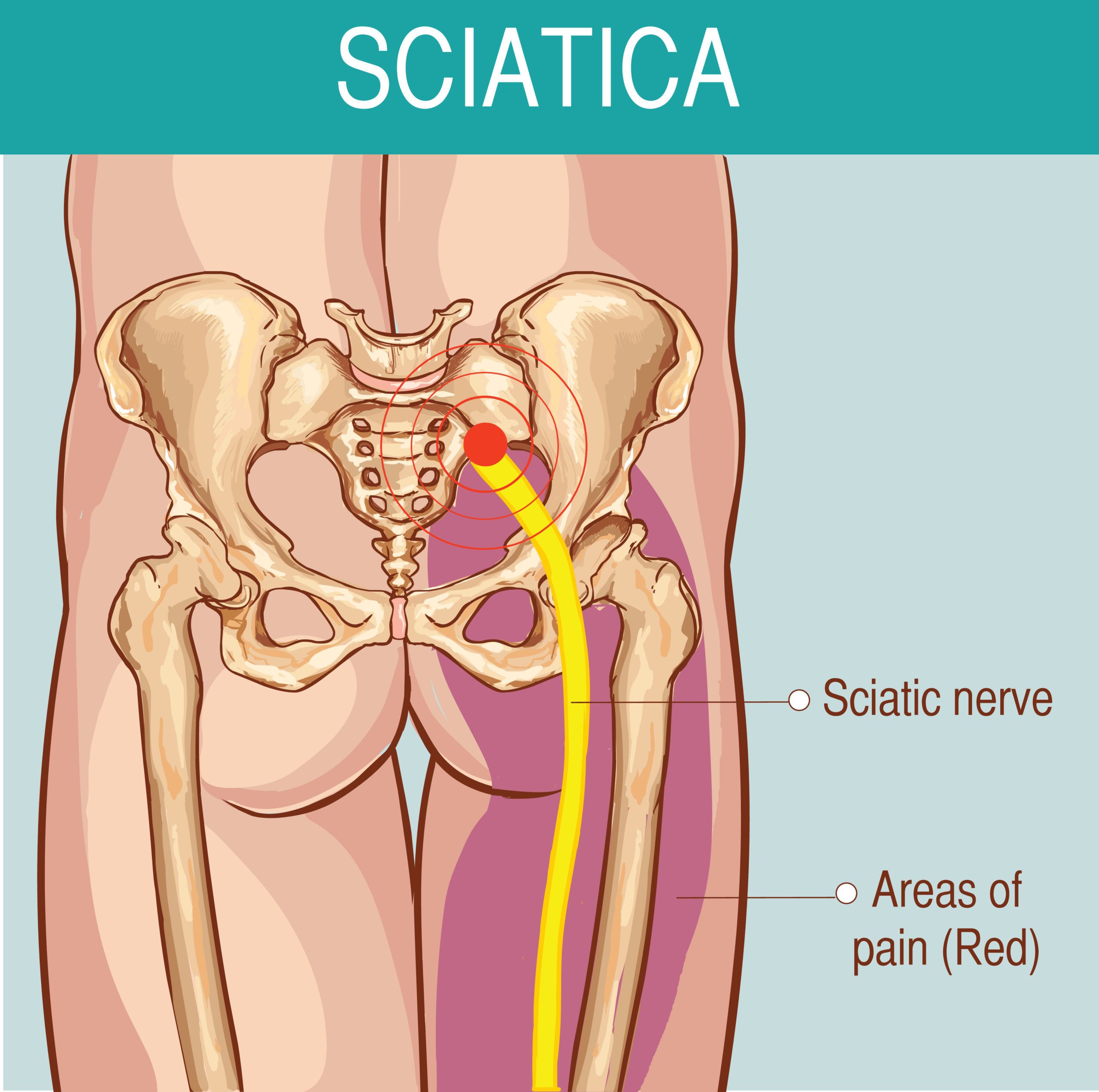 Sciatica Overview
