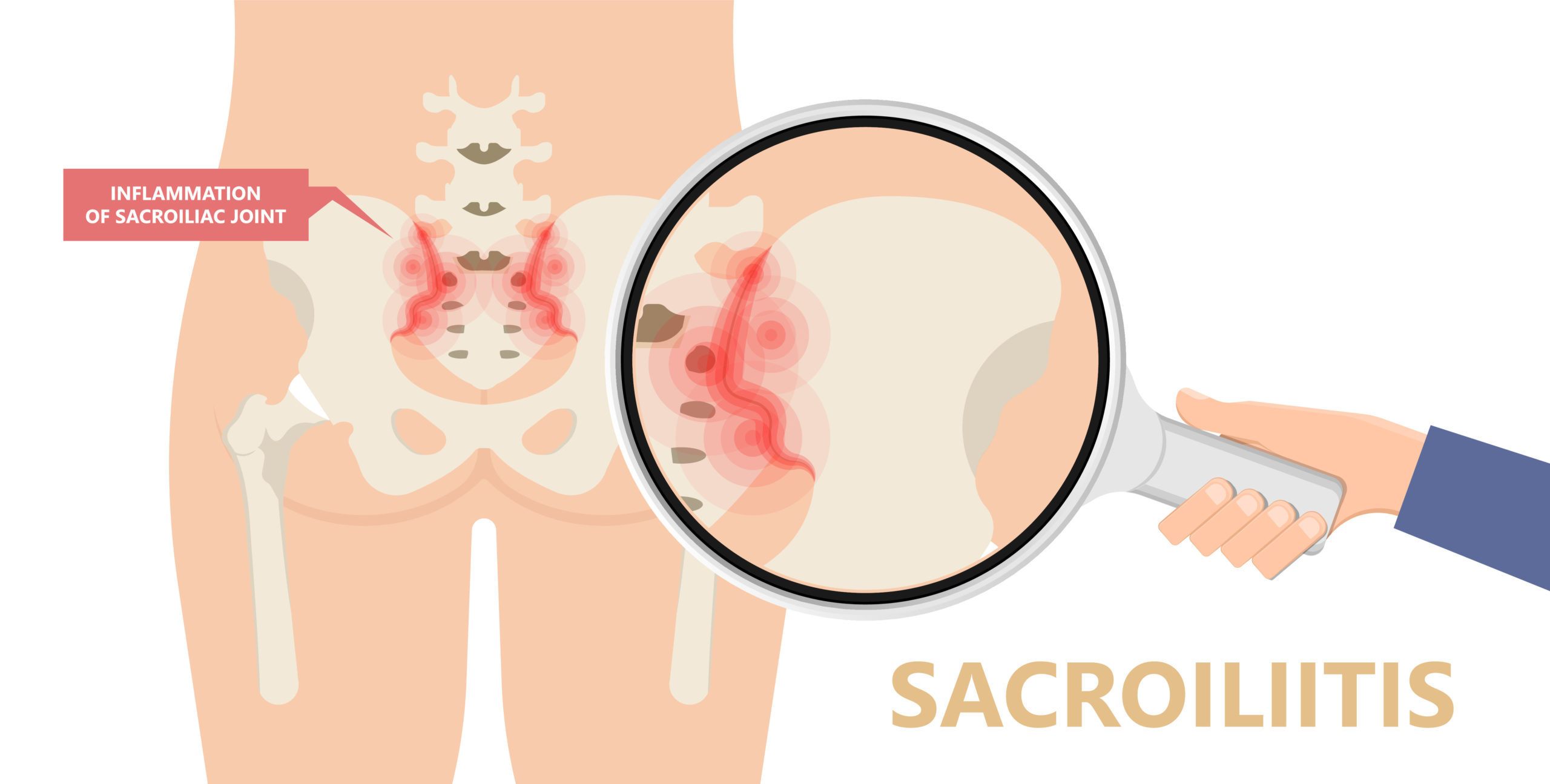 Sacroiliitis pain of sacroiliac joints and hips lupus legs physical exam ulcerative colitis infection swelling ligaments breakdown psoriasis Trauma Obesity Gout