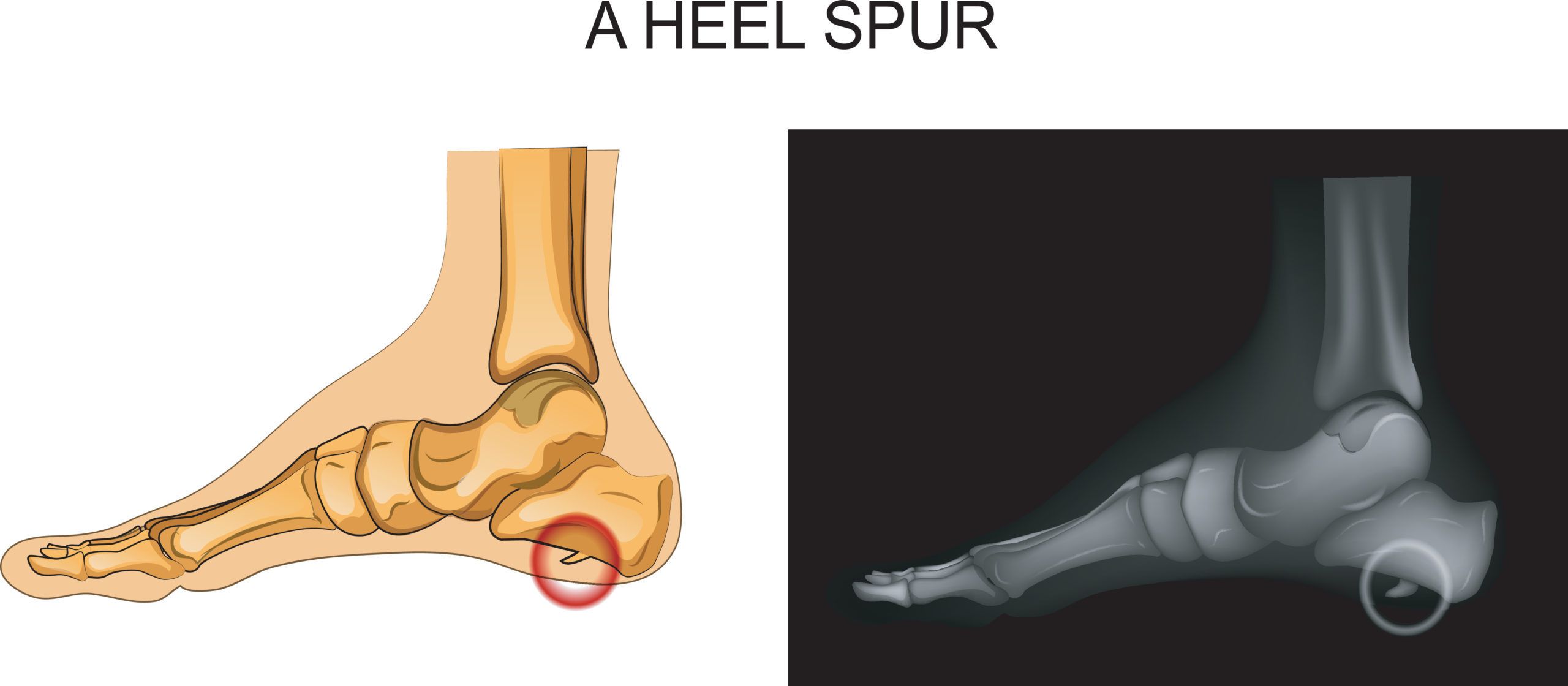 Can You Remove a Heel Spur? Heel Spur Surgery 101 | Northwest Surgery Center