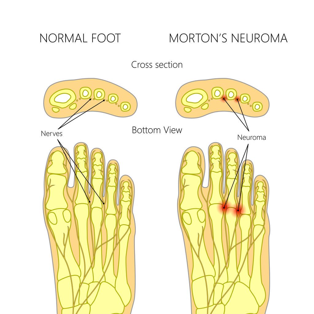 Morton's neuroma with cross section.