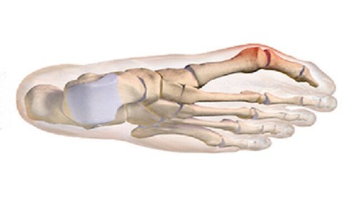 illustrated graphic of a bunion