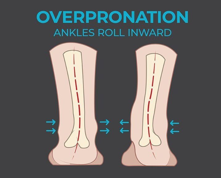 an illustration of overpronated feet