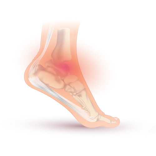 illustration of an ankle sprain