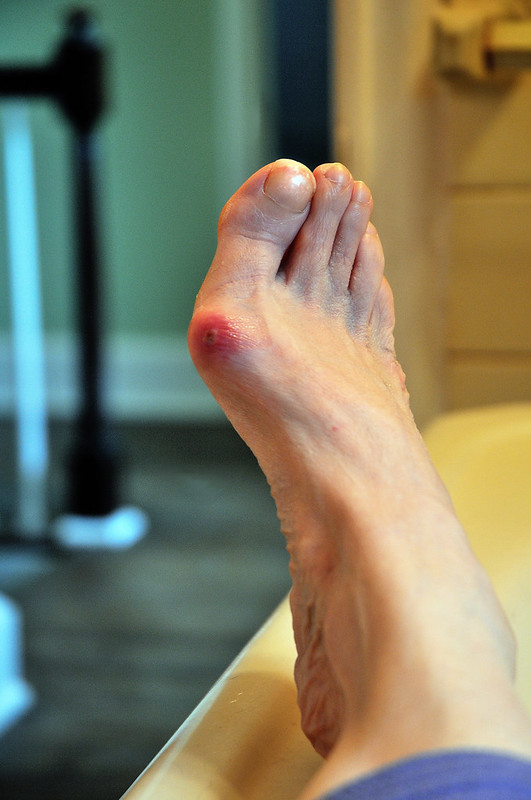 person with a foot bunion at a podiatrist in Chicago, IL
