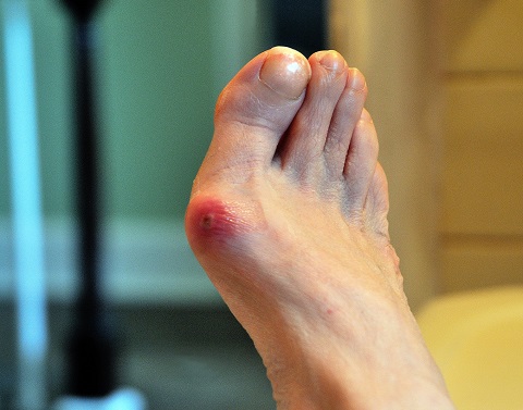 Bunion on a foot