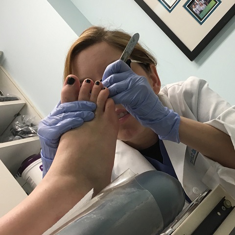 person getting athletes foot treatment in chicago, il