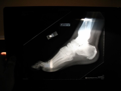 foot xray of someone with bone spurs